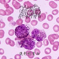 Progressive Anemia